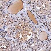 IHC staining of FFPE human thyroid papillary carcinoma tissue with SNF2L2 antibody. HIER: boil tissue sections in pH8 EDTA for 20 min and allow to cool before testing.