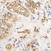 IHC staining of FFPE human right renal oncocytoma tissue with SNF2L2 antibody. HIER: boil tissue sections in pH8 EDTA for 20 min and allow to cool before testing.