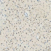 IHC staining of FFPE human glioblastoma tissue with SNF2L2 antibody. HIER: boil tissue sections in pH8 EDTA for 20 min and allow to cool before testing.
