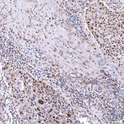 IHC staining of FFPE human esophageal squamous carcinoma tissue with SNF2L2 antibody. HIER: boil tissue sections in pH8 EDTA for 20 min and allow to cool before testing.