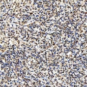 IHC staining of FFPE human diffuse large B cell lymphoma tissue with SNF2L2 antibody. HIER: boil tissue sections in pH8 EDTA for 20 min and allow to cool before testing.