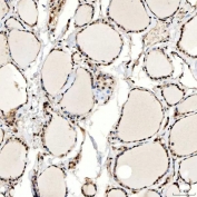 IHC staining of FFPE human thyroid papillary carcinoma tissue with SNF2H antibody. HIER: boil tissue sections in pH8 EDTA for 20 min and allow to cool before testing.