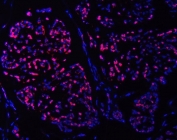 Immunofluorescent staining of FFPE human breast cancer tissue with SMC6 antibody (red) and DAPI nuclear stain (blue). HIER: steam section in pH8 EDTA buffer for 20 min.