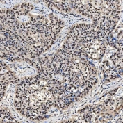 IHC staining of FFPE human larynx squamous cell carcinoma tissue with PAO-1 antibody. HIER: boil tissue sections in pH8 EDTA for 20 min and allow to cool before testing.