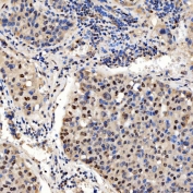 IHC staining of FFPE human liver cancer tissue with PAO-1 antibody. HIER: boil tissue sections in pH8 EDTA for 20 min and allow to cool before testing.