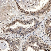 IHC staining of FFPE human endometrioid adenocarcinoma tissue with PAO-1 antibody. HIER: boil tissue sections in pH8 EDTA for 20 min and allow to cool before testing.