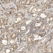IHC staining of FFPE human prostate adenocarcinoma tissue with PAO-1 antibody. HIER: boil tissue sections in pH8 EDTA for 20 min and allow to cool before testing.