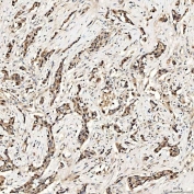 IHC staining of FFPE human lung adenocarcinoma tissue with PAO-1 antibody. HIER: boil tissue sections in pH8 EDTA for 20 min and allow to cool before testing.