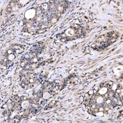 IHC staining of FFPE human duodenal papilla adenocarcinoma tissue with PAO-1 antibody. HIER: boil tissue sections in pH8 EDTA for 20 min and allow to cool before testing.
