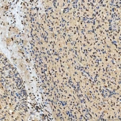 IHC staining of FFPE human glioblastoma tissue with PAO-1 antibody. HIER: boil tissue sections in pH8 EDTA for 20 min and allow to cool before testing.