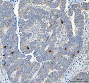 IHC staining of FFPE human colorectal adenocarcinoma tissue with CHGA antibody. HIER: boil tissue sections in pH8 EDTA for 20 min and allow to cool before testing.