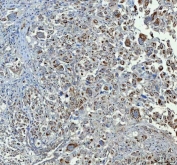 IHC staining of FFPE human lung adenocarcinoma tissue with CHGA antibody. HIER: boil tissue sections in pH8 EDTA for 20 min and allow to cool before testing.