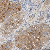 IHC staining of FFPE human liver cancer tissue with Syntaphilin antibody. HIER: boil tissue sections in pH8 EDTA for 20 min and allow to cool before testing.