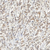 IHC staining of FFPE human breast cancer tissue with Syntaphilin antibody. HIER: boil tissue sections in pH8 EDTA for 20 min and allow to cool before testing.