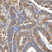 IHC staining of FFPE human rectum adenocarcinoma tissue with Syntaphilin antibody. HIER: boil tissue sections in pH8 EDTA for 20 min and allow to cool before testing.