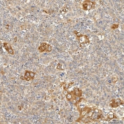 IHC staining of FFPE human larynx squamous cell carcinoma tissue with Syntaphilin antibody. HIER: boil tissue sections in pH8 EDTA for 20 min and allow to cool before testing.