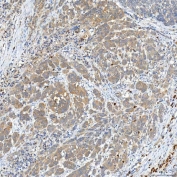 IHC staining of FFPE human prostate adenocarcinoma tissue with Syntaphilin antibody. HIER: boil tissue sections in pH8 EDTA for 20 min and allow to cool before testing.