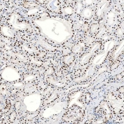 IHC staining of FFPE human prostate adenocarcinoma tissue with SNRNP40 antibody. HIER: boil tissue sections in pH8 EDTA for 20 min and allow to cool before testing.