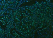Immunofluorescent staining of FFPE human lung cancer tissue with U2 snRNP A antibody (green) and DAPI nuclear stain (blue). HIER: steam section in pH8 EDTA buffer for 20 min.
