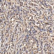 IHC staining of FFPE human lung adenocarcinoma tissue with U2 snRNP A antibody. HIER: boil tissue sections in pH8 EDTA for 20 min and allow to cool before testing.