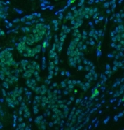 Immunofluorescent staining of FFPE human breast cancer tissue with U1 snRNP C antibody (green) and DAPI nuclear stain (blue). HIER: steam section in pH8 EDTA buffer for 20 min.