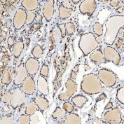 IHC staining of FFPE human thyroid papillary carcinoma tissue with U1 snRNP C antibody. HIER: boil tissue sections in pH8 EDTA for 20 min and allow to cool before testing.