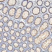 IHC staining of FFPE human colon adenocarcinoma tissue with U1 snRNP C antibody. HIER: boil tissue sections in pH8 EDTA for 20 min and allow to cool before testing.