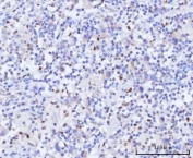 IHC staining of FFPE human testicular seminoma tissue with RAD51C antibody. HIER: boil tissue sections in pH8 EDTA for 20 min and allow to cool before testing.