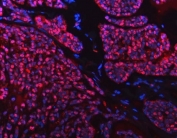 Immunofluorescent staining of FFPE human breast cancer tissue with Sm-D2 antibody (red) and DAPI nuclear stain (blue). HIER: steam section in pH8 EDTA buffer for 20 min.