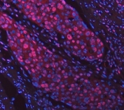 Immunofluorescent staining of FFPE human squamous carcinoma tissue with Sm-D2 antibody (red) and DAPI nuclear stain (blue). HIER: steam section in pH8 EDTA buffer for 20 min.