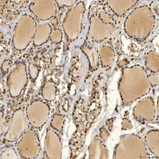 IHC staining of FFPE human thyroid papillary carcinoma tissue with Sm-D2 antibody. HIER: boil tissue sections in pH8 EDTA for 20 min and allow to cool before testing.