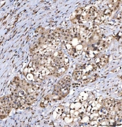 IHC staining of FFPE human appendix adenocarcinoma tissue with Sm-D2 antibody. HIER: boil tissue sections in pH8 EDTA for 20 min and allow to cool before testing.