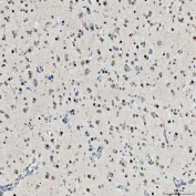 IHC staining of FFPE human glioblastoma tissue with Sm-D2 antibody. HIER: boil tissue sections in pH8 EDTA for 20 min and allow to cool before testing.