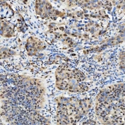 IHC staining of FFPE human urothelial carcinoma tissue with Sm-D2 antibody. HIER: boil tissue sections in pH8 EDTA for 20 min and allow to cool before testing.