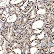 IHC staining of FFPE human prostate adenocarcinoma tissue with Sm-D2 antibody. HIER: boil tissue sections in pH8 EDTA for 20 min and allow to cool before testing.