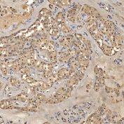 IHC staining of FFPE human right renal oncocytoma tissue with Sm-D2 antibody. HIER: boil tissue sections in pH8 EDTA for 20 min and allow to cool before testing.