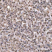 IHC staining of FFPE human liver cancer tissue with Sm-D2 antibody. HIER: boil tissue sections in pH8 EDTA for 20 min and allow to cool before testing.