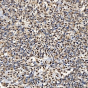 IHC staining of FFPE human diffuse large B-cell lymphoma tissue with Sm-D2 antibody. HIER: boil tissue sections in pH8 EDTA for 20 min and allow to cool before testing.