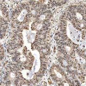 IHC staining of FFPE human endometrioid adenocarcinoma tissue with Sm-D2 antibody. HIER: boil tissue sections in pH8 EDTA for 20 min and allow to cool before testing.