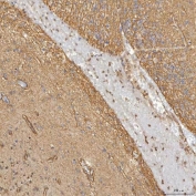 IHC staining of FFPE human glioblastoma tissue with Sm-D3 antibody. HIER: boil tissue sections in pH8 EDTA for 20 min and allow to cool before testing.