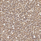 IHC staining of FFPE human liver cancer tissue with Sm-D3 antibody. HIER: boil tissue sections in pH8 EDTA for 20 min and allow to cool before testing.