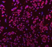 Immunofluorescent staining of FFPE human breast cancer tissue with Sm-D3 antibody (red) and DAPI nuclear stain (blue). HIER: steam section in pH8 EDTA buffer for 20 min.