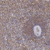 IHC staining of FFPE human prostate adenocarcinoma tissue with Sm-D3 antibody. HIER: boil tissue sections in pH8 EDTA for 20 min and allow to cool before testing.