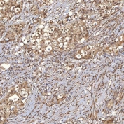 IHC staining of FFPE human breast cancer tissue with Sm-D3 antibody. HIER: boil tissue sections in pH8 EDTA for 20 min and allow to cool before testing.