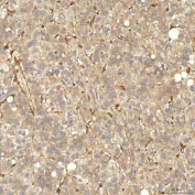 IHC staining of FFPE human liver cancer tissue with Sorting nexin 4 antibody. HIER: boil tissue sections in pH8 EDTA for 20 min and allow to cool before testing.