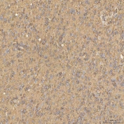 IHC staining of FFPE human glioblastoma tissue with Sorting nexin 4 antibody. HIER: boil tissue sections in pH8 EDTA for 20 min and allow to cool before testing.