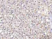 IHC staining of FFPE human liver cancer tissue with Retinol Binding Protein 1 antibody. HIER: boil tissue sections in pH8 EDTA for 20 min and allow to cool before testing.
