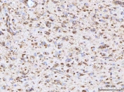 IHC staining of FFPE human glioblastoma tissue with Retinol Binding Protein 1 antibody. HIER: boil tissue sections in pH8 EDTA for 20 min and allow to cool before testing.