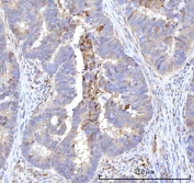 IHC staining of FFPE human rectum adenocarcinoma tissue with Retinol Binding Protein 1 antibody. HIER: boil tissue sections in pH8 EDTA for 20 min and allow to cool before testing.