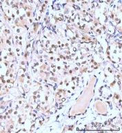 IHC staining of FFPE human thyroid papillary carcinoma tissue with Nesprin 3 antibody. HIER: boil tissue sections in pH8 EDTA for 20 min and allow to cool before testing.